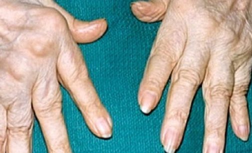 Ревматоидный артрит может развиться из-за инфекции на дёснах — врач