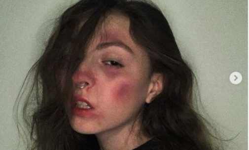 «Как вы относитесь к современным трендам?»: дочь Поляковой ужаснула «синяками» на лице